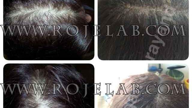 فیلم آموزش میکروپیگمنتیشن برای پوست سر - اسکالپ سر - scalp