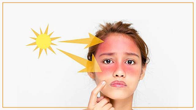 روش های خانگی موثر برای درمان آفتاب سوختگی