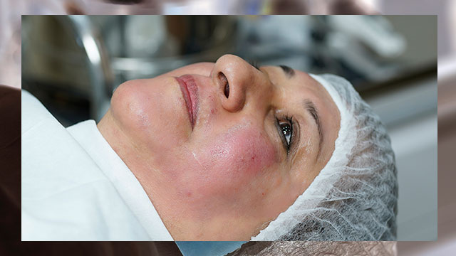 کاهش چین و چروک پوست | لیفت پوست صورت | پلاسما تراپی
